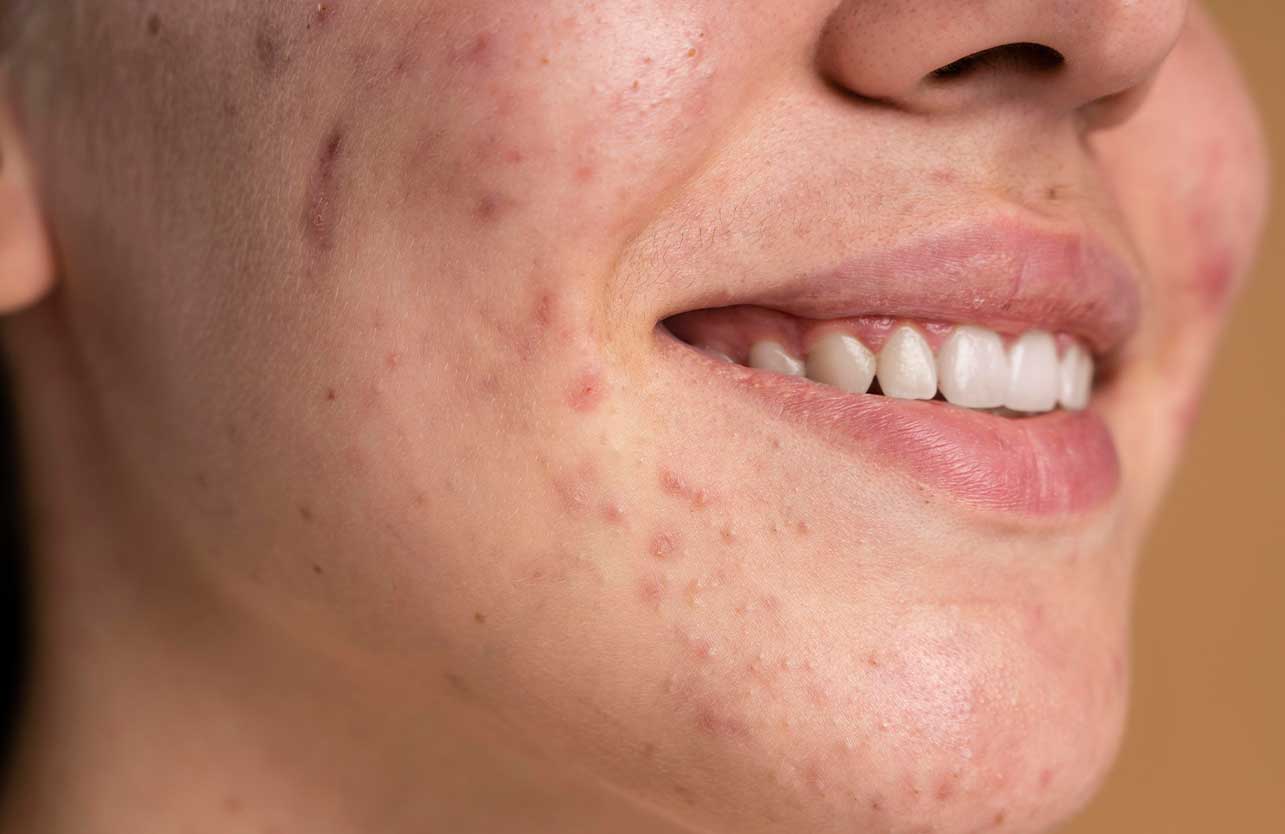 What is Acne, What Causes It, and How Is It Treated?