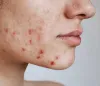 Side Effects of Medications Used in Acne Treatment