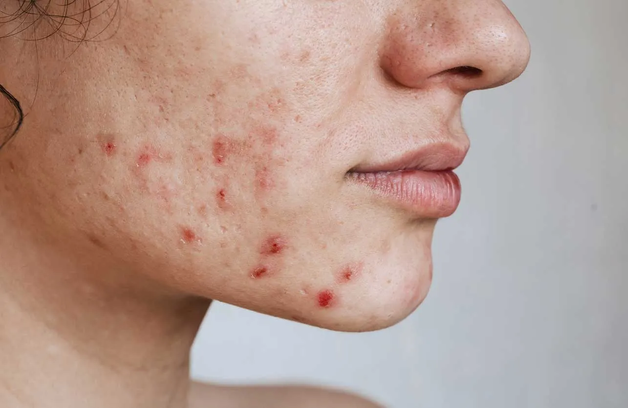 Side Effects of Medications Used in Acne Treatment