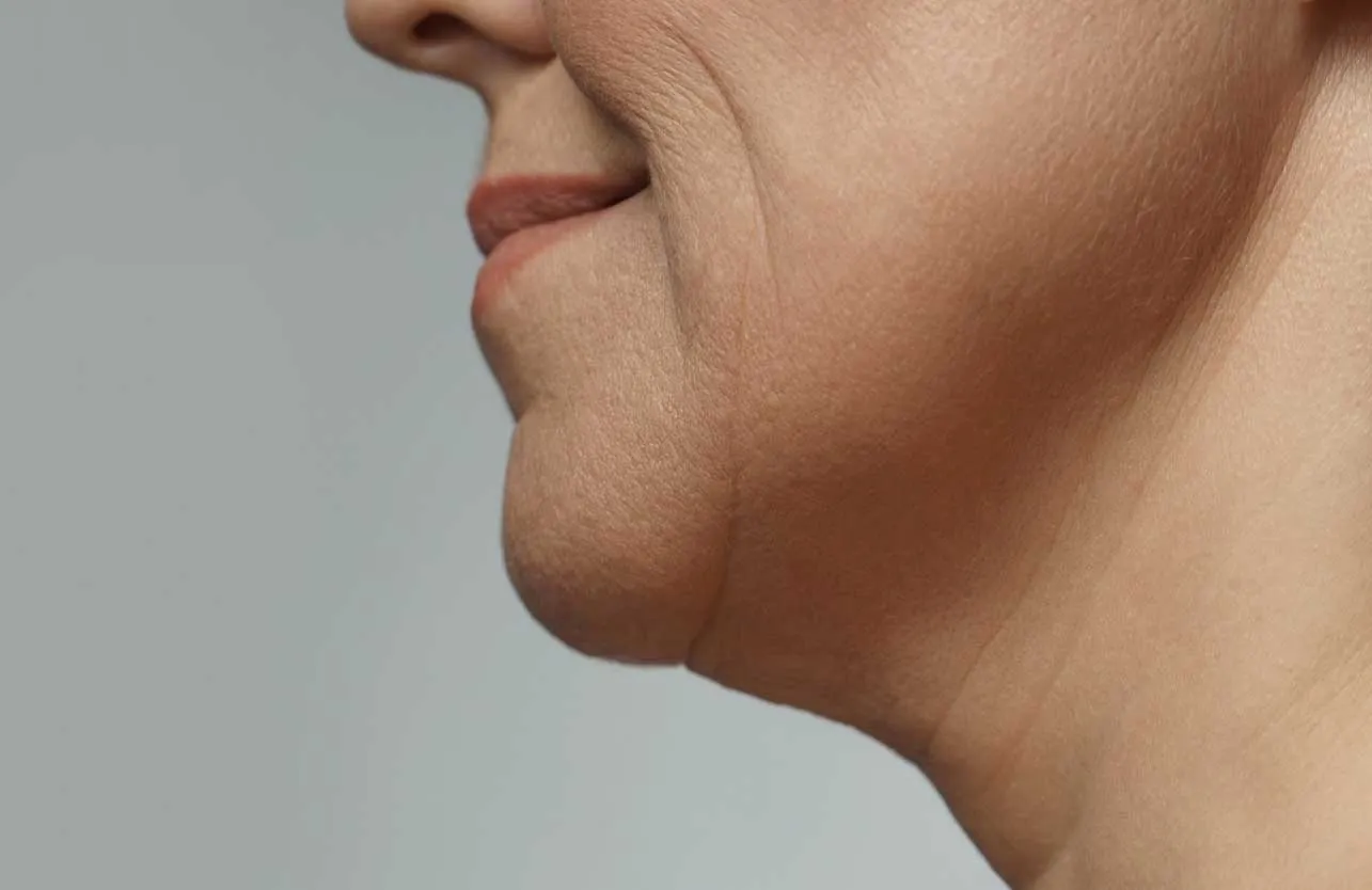 How to Treat Sagging in the Neck Area?
