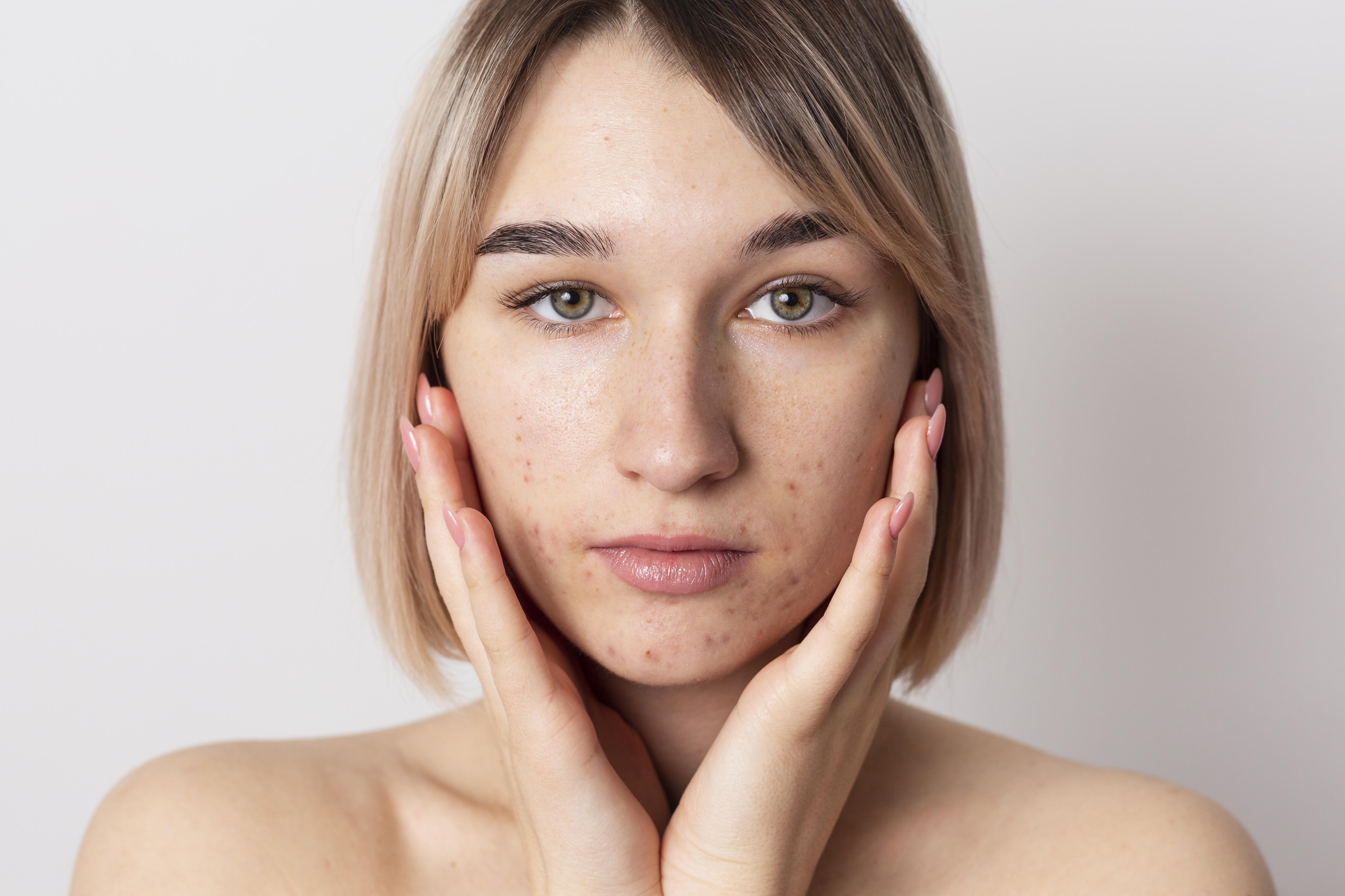 Laser or Chemical Peeling for Acne Scars?