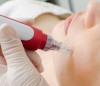 Dermapen ve Cilt Üzerindeki Etkileri