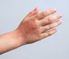 Egzama ve Stres İlişkisi: Psikodermatoloji Yaklaşımı