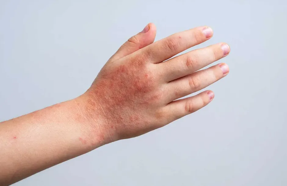The Link Between Eczema and Stress: A Psychodermatology Approach