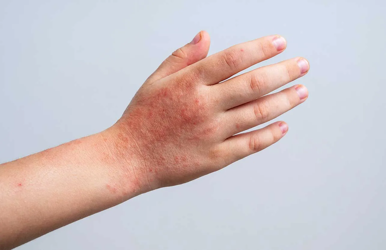 Egzama ve Stres İlişkisi: Psikodermatoloji Yaklaşımı