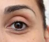 The Best Treatment Options for Under-Eye Bags