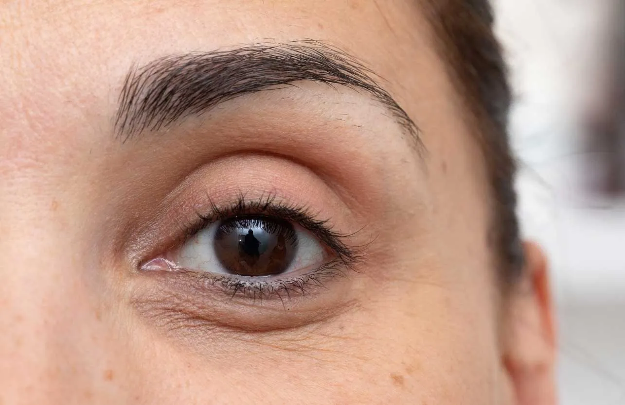 The Best Treatment Options for Under-Eye Bags