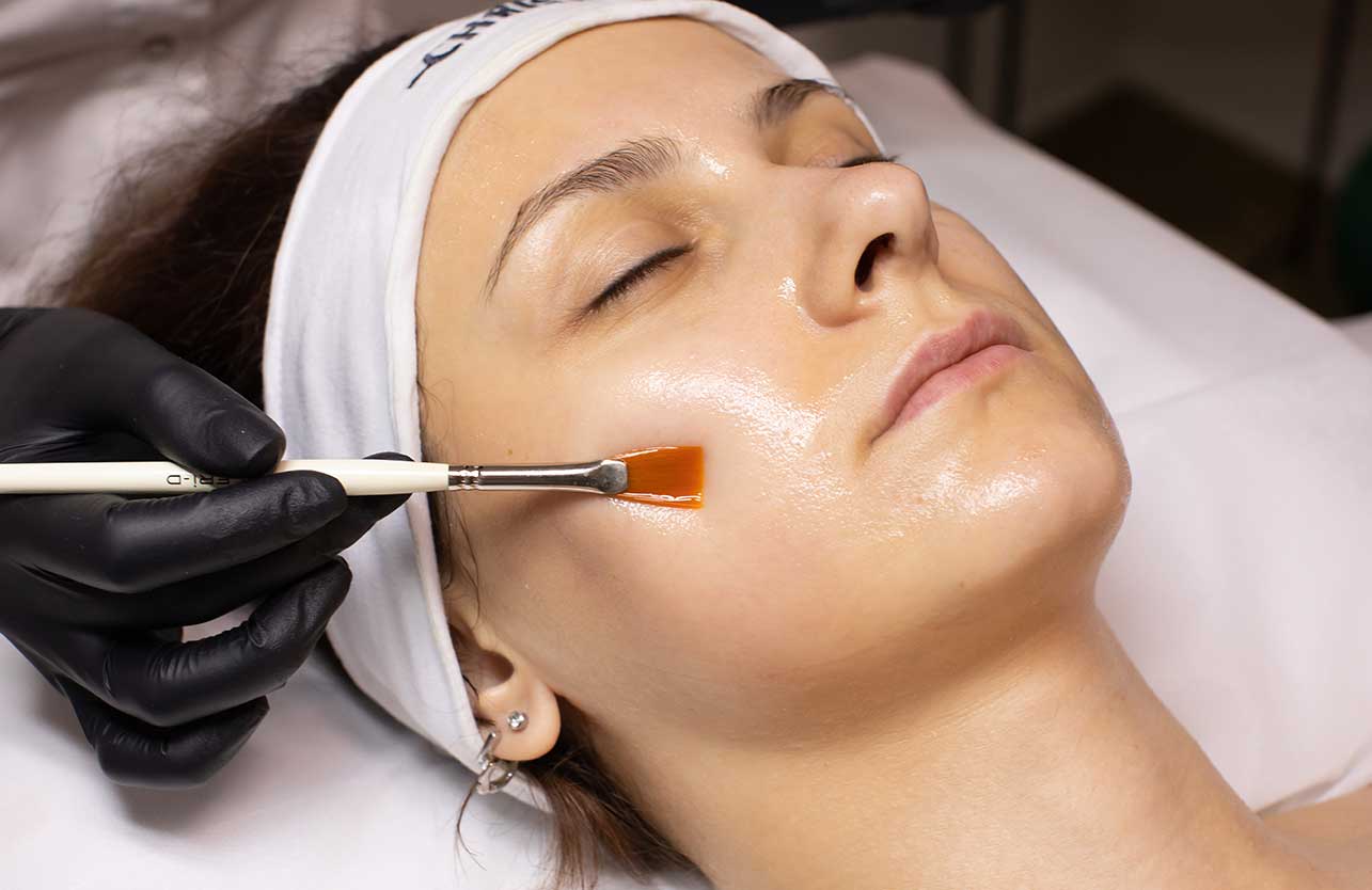 Kimyasal Peeling ile Cilt Yenileme Nasıl Yapılır?
