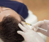 Hair Loss Treatment with Mesotherapy