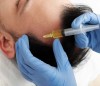 PRP (Platelet Rich Plasma) ile Saç ve Cilt Tedavisi