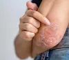 New Treatment Methods for Psoriasis