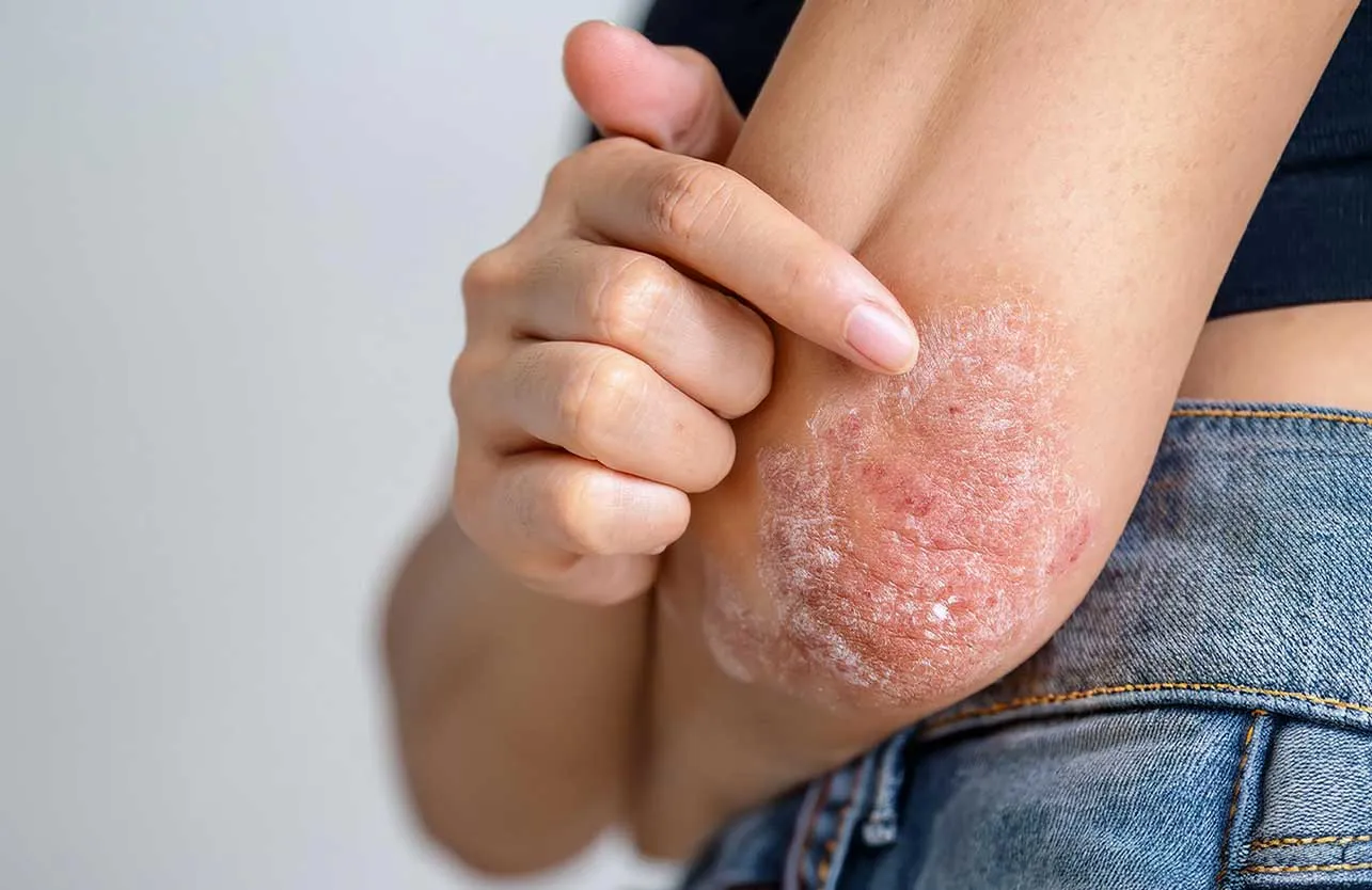 New Treatment Methods for Psoriasis