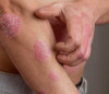 The Role of Nutrition in Psoriasis Management