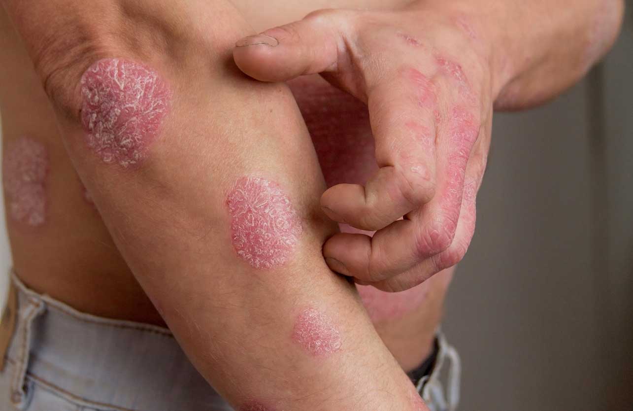 The Role of Nutrition in Psoriasis Management
